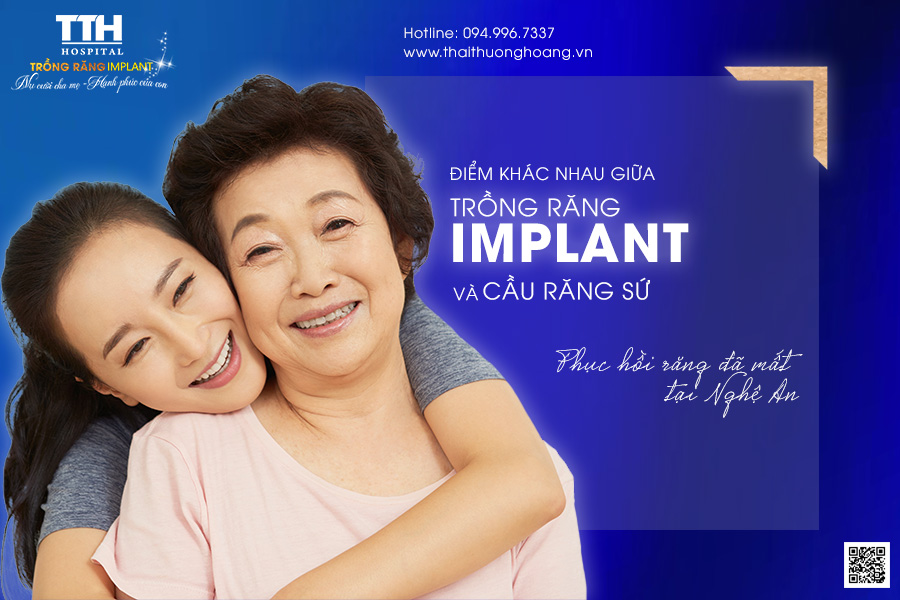 Sự khác biệt giữa trồng răng Implant và cầu răng sứ. Phục hồi răng đã mất tại Nghệ An
